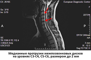 протрузии шеи