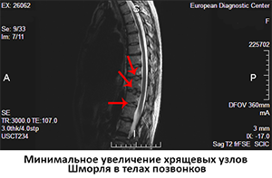 МРТ грудного отдела позвоночника