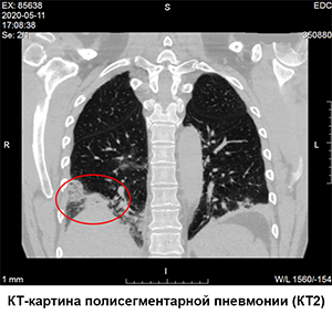 ковид 19, кт пневмония