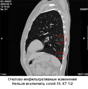 коронавирус на кт, сделать кт легких